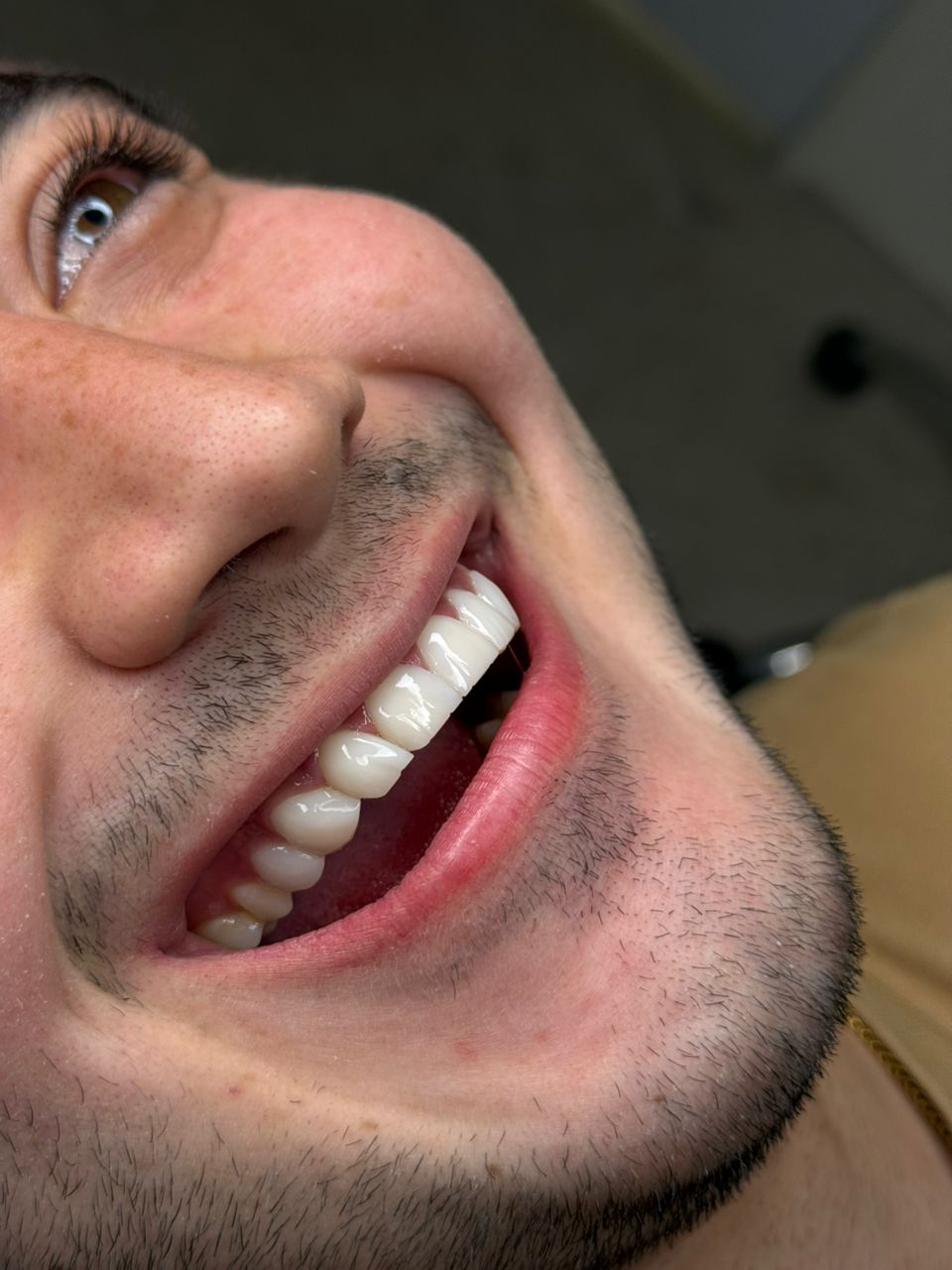 نمونه درمان زیبایی دندان در کلینیک دندانپزشکی دکتر مرضیه حسینی، دندانپزشکی طرف قرارداد بیمه البرز در تهران