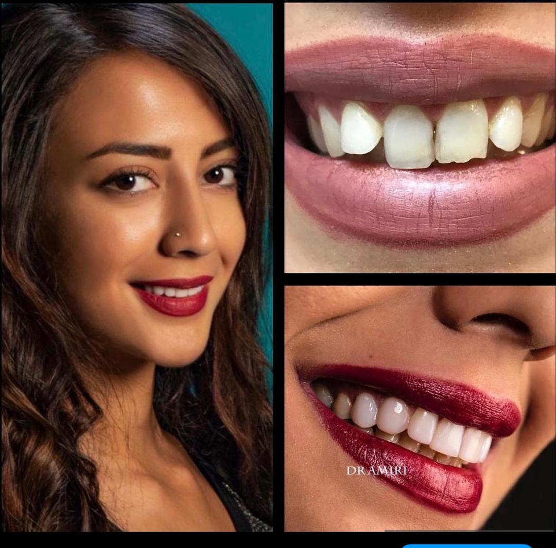 نمونه ایمپلنت تمام دیجیتال در کلینیک دکتر امیری؛ دندانپزشکی طرف قرارداد با بیمه کوثر در تهران