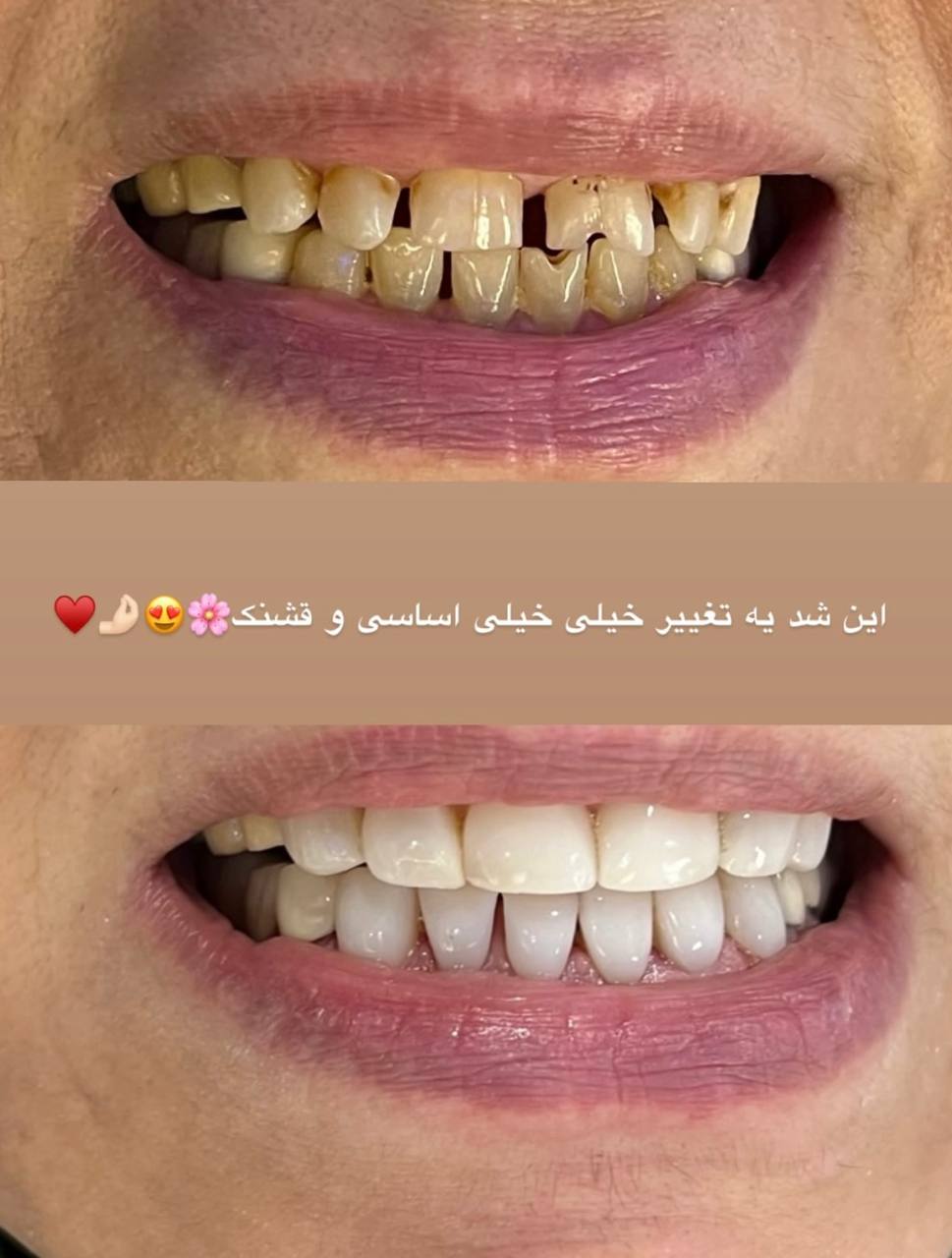 قبل و بعد از خدمات دندانپزشکی در بهترین کلینیک دندانپزشکی طرف قرارداد بیمه در تهران