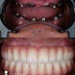 tehranimplant (3)