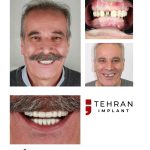 tehranimplant (5)