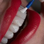 dr-fatemeh-foroozesh-implant-cosmetic-dentist-tehran (11)