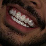 dr-fatemeh-foroozesh-implant-cosmetic-dentist-tehran (12)