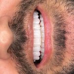 dr-fatemeh-foroozesh-implant-cosmetic-dentist-tehran (13)
