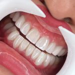 dr-fatemeh-foroozesh-implant-cosmetic-dentist-tehran (5)