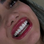 dr-fatemeh-foroozesh-implant-cosmetic-dentist-tehran (6)