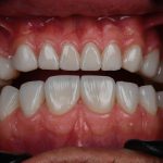 dr-fatemeh-foroozesh-implant-cosmetic-dentist-tehran (9)
